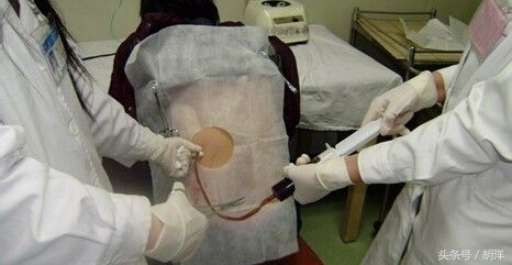 胸腔积液怎么治才能除根,胸腔积液怎么治才能彻底除根