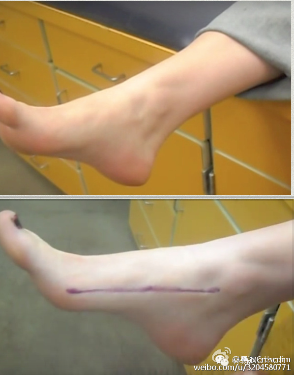 扁平足的矫正方法,2岁扁平足需要矫正么