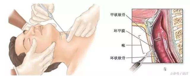 异物呛入气管的急救,呛到气管里异物急救法