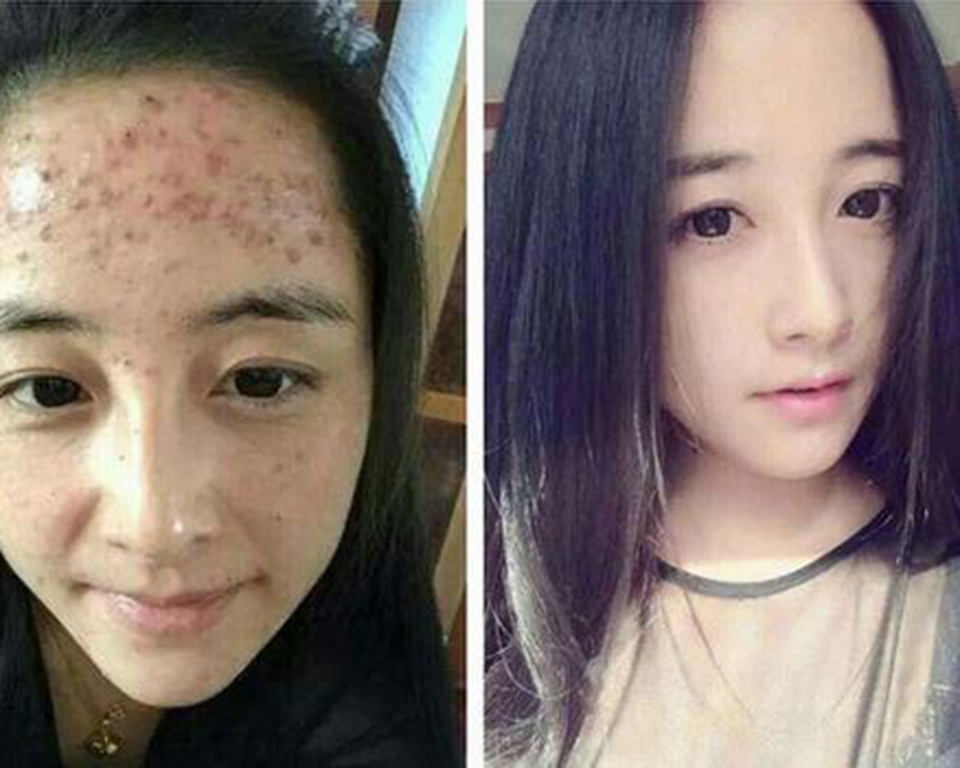 发际线长痘痘是什么原因，如何祛痘