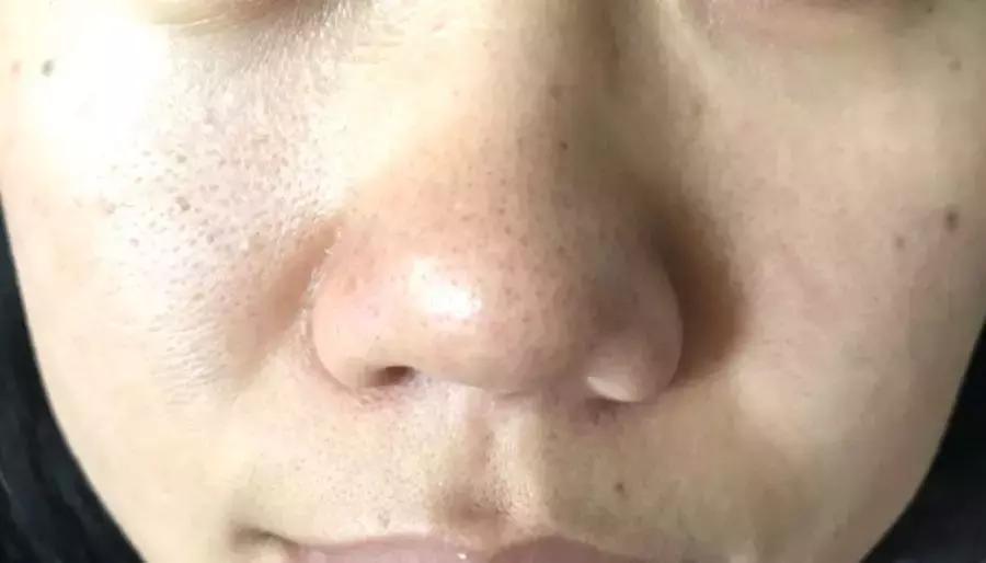 出油黑头毛孔粗大怎么办,毛孔粗大黑头多脸爱出油怎么解决