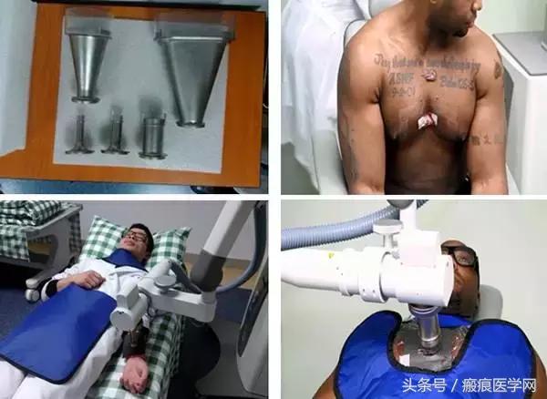 浅层放射治疗疤痕疙瘩,浅层x射线治疗疤痕疙瘩费用