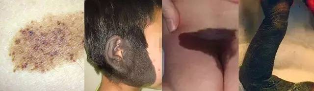 初生婴儿痣和胎记怎么区别,孩子长痣和胎记区别