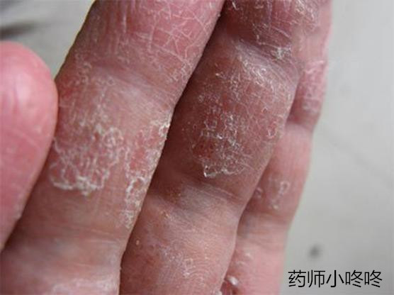 皮肤真菌感染要注意什么,皮肤真菌感染应该注意什么