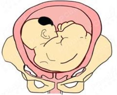 正常胎位是什么胎位,胎位大全