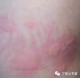 儿童皮肤病防治知识大全,儿童皮肤科护理流程