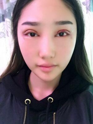 全切双眼皮会变内双吗,双眼皮全切六毫米会不会变内双