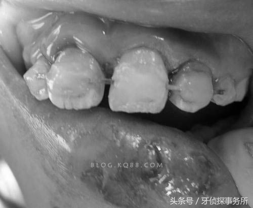 宝宝不小心磕到头有事吗,如果乳牙被磕伤了怎么办