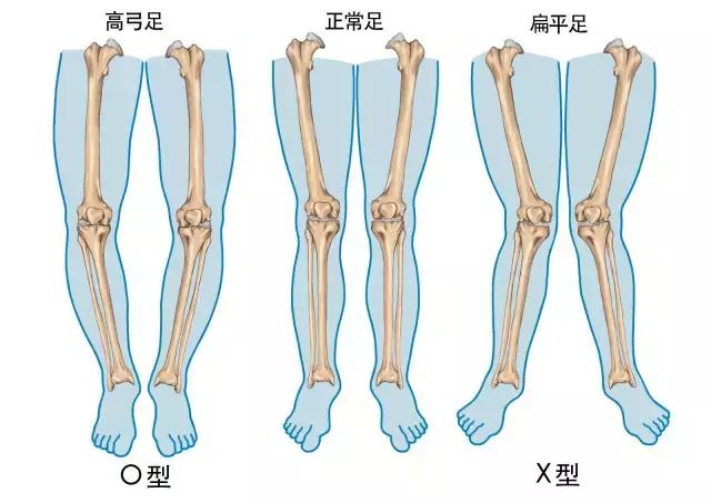 长时间走路脚跟痛怎么解决,足弓和脚后跟痛怎么回事