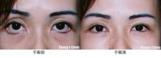 做眼袋后下眼睑外翻有办法解决吗,眼睑外翻怎么办