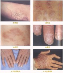 司库奇尤单抗治疗牛皮癣对比图,tildrakizumab副作用