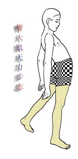 臀大肌无力的康复治疗,臀大肌无力导致骨盆前倾