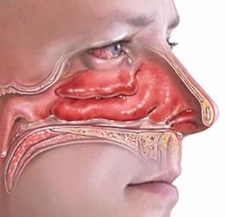 慢性鼻炎需要治疗吗,治疗慢性鼻炎的药物