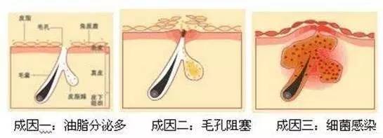 嘴下巴反复长痘是什么原因引起的,中年女人下巴反复长痘是什么原因