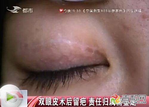 长春市铭医整形美容医院双眼皮,长春铭医整形医院双眼皮案例