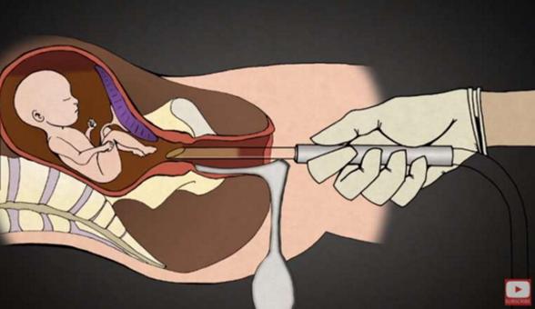 堕胎手术详细流程,女性堕胎手术的可怕真相