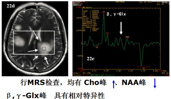 医学干货：瘤样炎性脱髓鞘病与胶质瘤、PCNSL临床、影像鉴别
