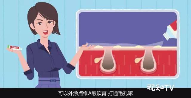 异维a酸红霉素凝胶去黑头缩毛孔,长沙医美去黑头缩毛孔大概多少钱