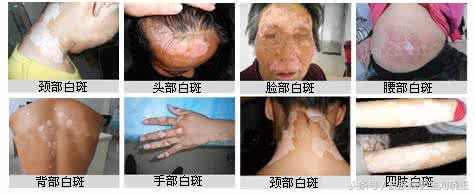 儿童白斑怎么治疗？白癜风是一种什么病？