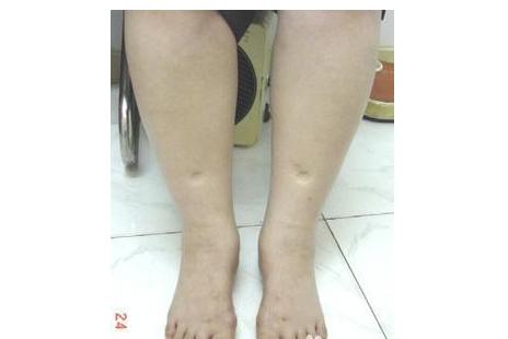 孕期妈妈预防水肿运动,准妈妈怎样避免孕期浮肿