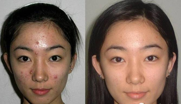 祛痘印痘坑公认最好的方法,祛痘痘印真实有效的方法不花钱