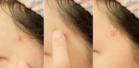额头长痘痘后要注意哪些?