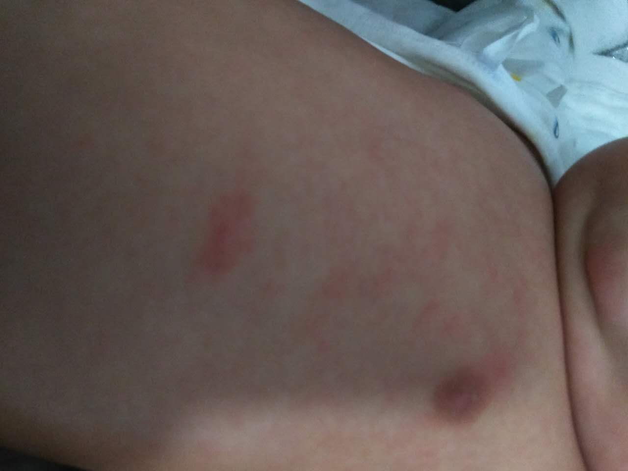 宝宝湿疹反复怎么办教你一招去除,宝宝湿疹反复怎么消除又快又好