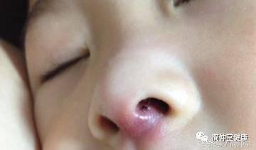 火疖子是什么样子的图片,火疖子是什么引起的