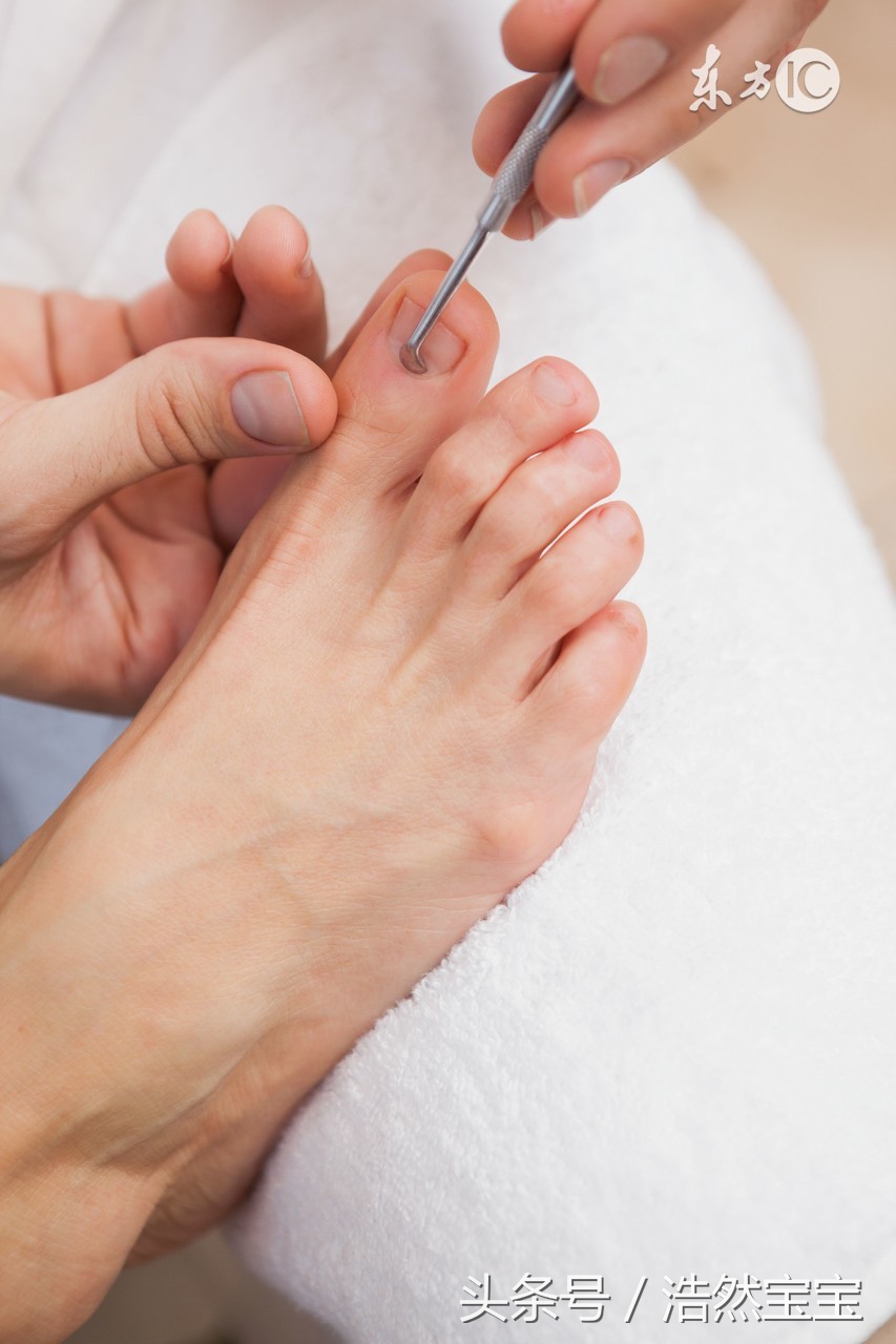 孩子灰指甲怎么治疗能彻底除根,小孩如何预防灰指甲