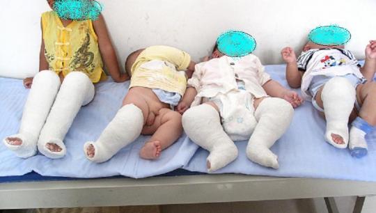 关于小儿“内翻足”的亲身经历，宝宝站不稳就一定是‘畸形’吗？