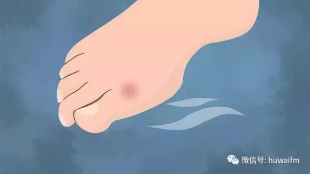 脚上长了水泡怎样才会好得快,一只脚上长水泡是什么原因引起的