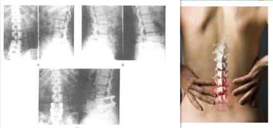 腰椎骨质增生怎么治疗最好得快,中医正骨能治骨质增生吗