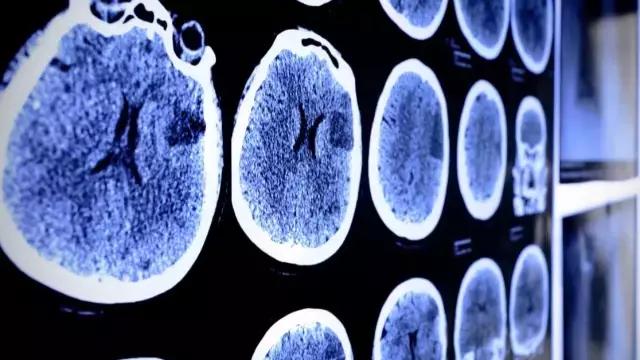 黑色素瘤脑转移治疗成功案例,黑色素瘤转移到脑怎么治