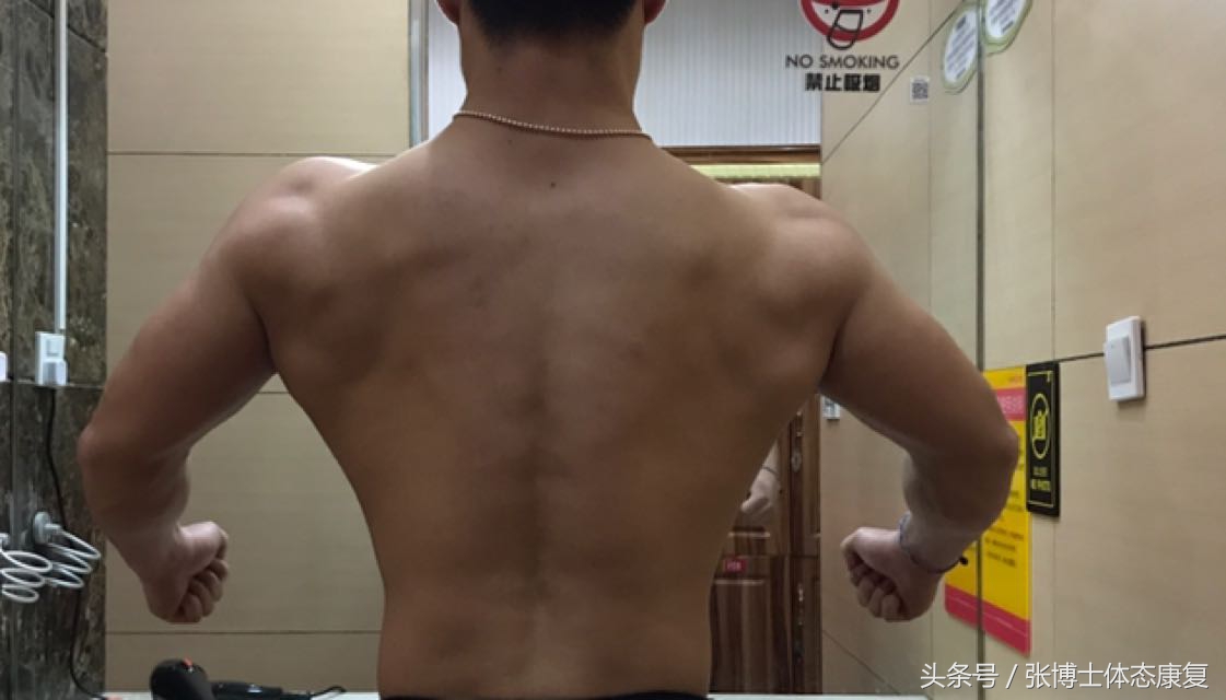 背书包高低肩最快的纠正方法,背书包驼背怎么纠正