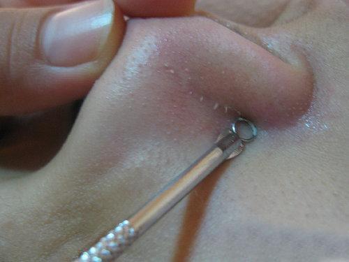 鼻子挤出的白色“条状物”是什么？要怎样才能将它们清理彻底！