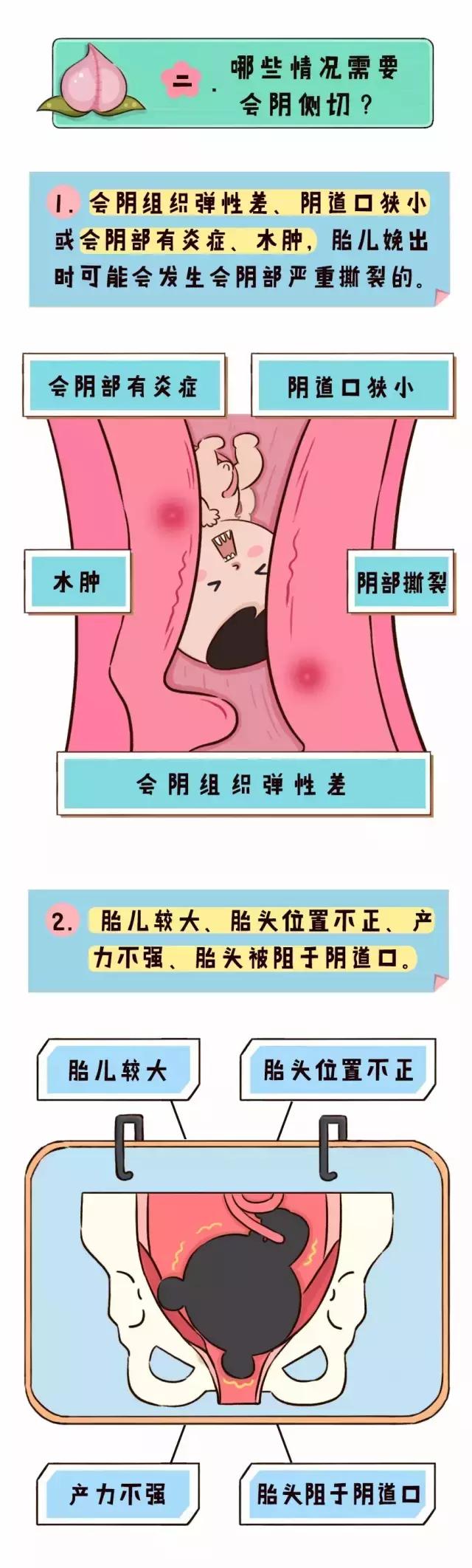 顺产也要挨一刀是真的吗,顺产可不可以不侧切