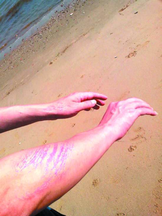 被水母蜇了怎么办小妙招,水母蜇人后抹什么药膏