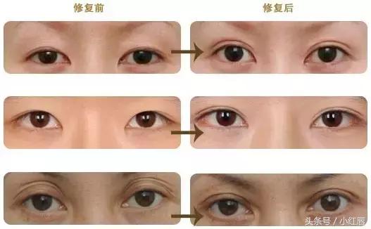你的眼睛适合做什么手术,你的双眼皮什么时候做