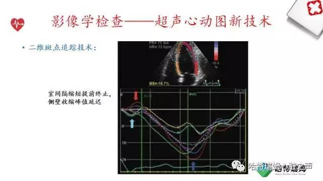 「心声」从机制到临床，一起认识左束支阻滞！