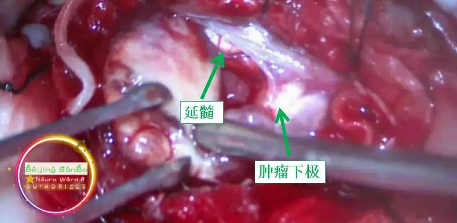 喝水容易呛是怎么回事是肺癌,老人喝水容易呛咳怎么办
