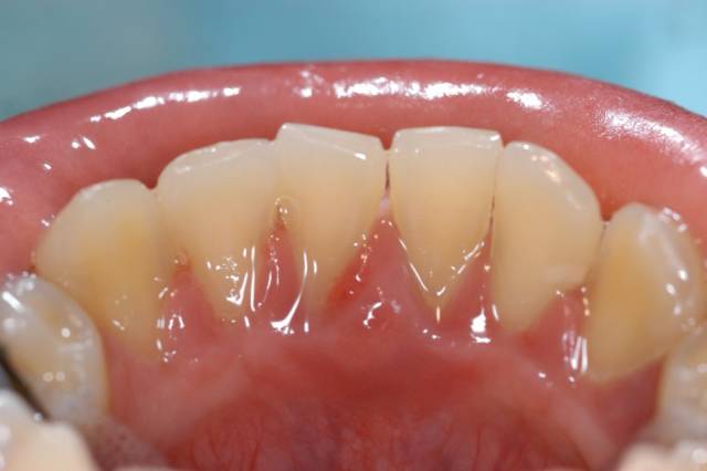 从来都没洗过牙的视频,有多少人从来没有洗过牙