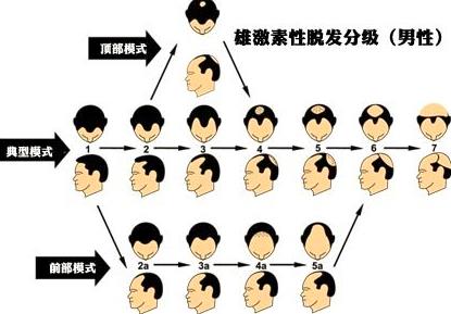 男性秃顶脱发去医院能治疗吗,男性秃顶脱发治疗最快的方法