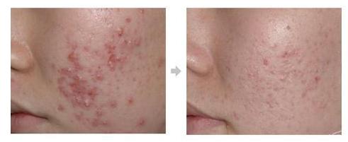 痘印区分,怎样判断自己是痘印还是痘坑