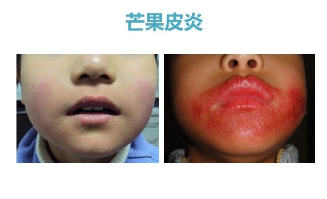 芒果皮炎渐好过程图片,宝宝芒果过敏症状治疗方法