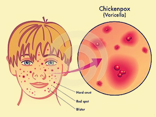 孕妇水痘的危害和治疗-米霞医生皮肤科系列科普（1）