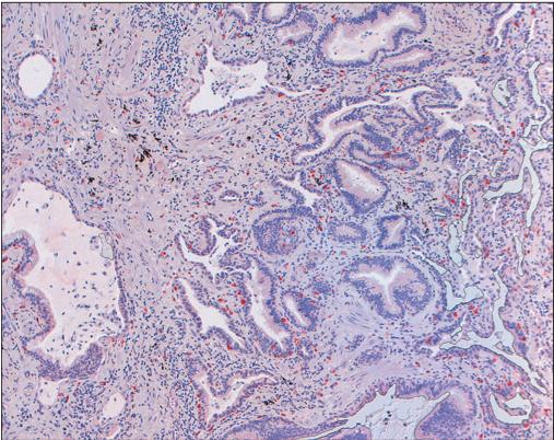 类风湿性关节炎的护理措施,类风湿性关节炎如何保护关节功能