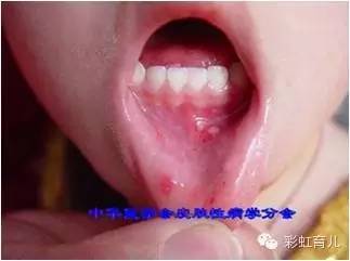 宝宝易出汗咳嗽,宝宝感冒气喘咳嗽怎么治疗最有效