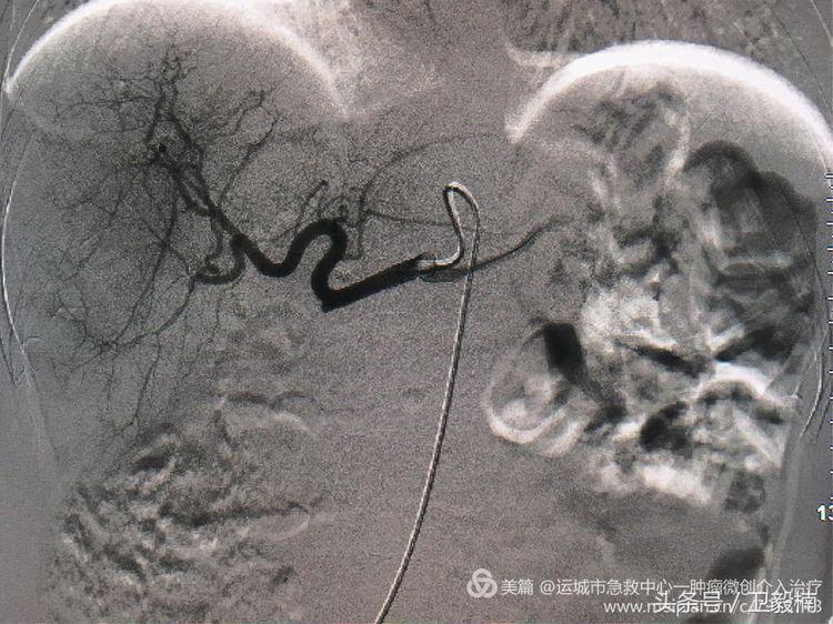 肝脏转移瘤用介入治疗有效吗,肝转移肿瘤介入治疗