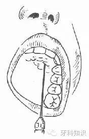 口腔拔牙图片,口腔拔牙麻醉多久消退
