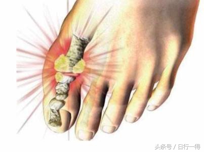 痛风风湿小常识,实习日志骨科个人小结